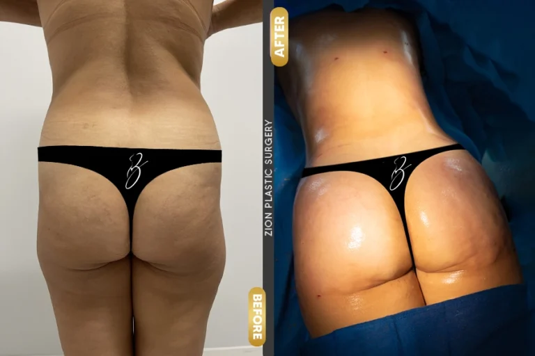 Brazilian Butt Lift