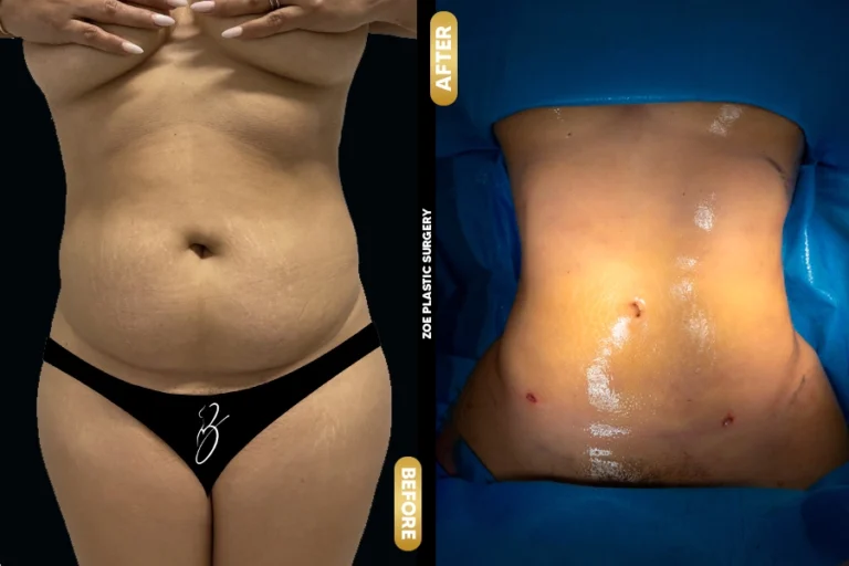 Lipo in Zoe Plastic Surgery