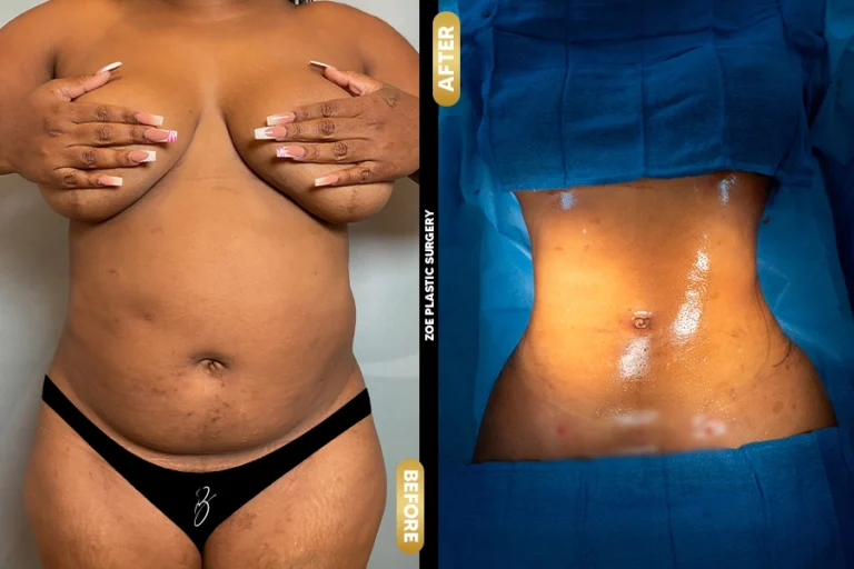 Liposuction