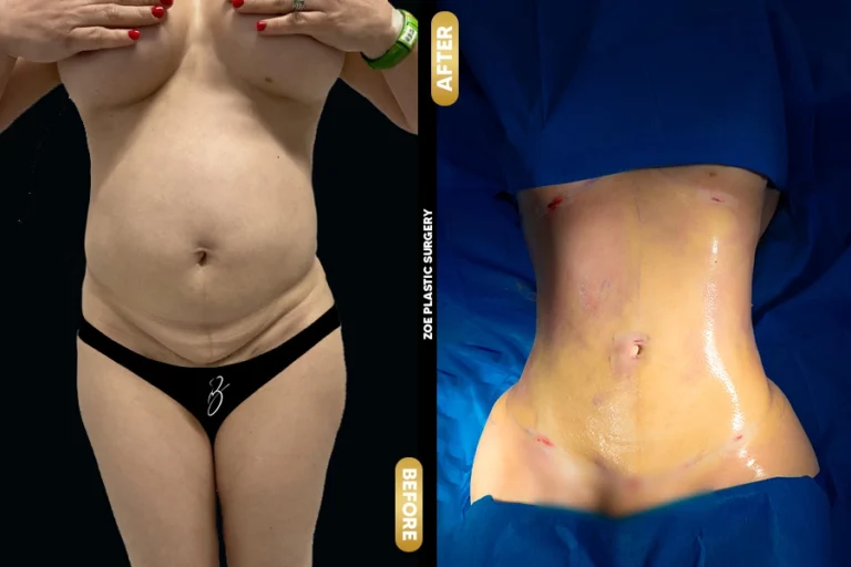 Liposuction in Miami