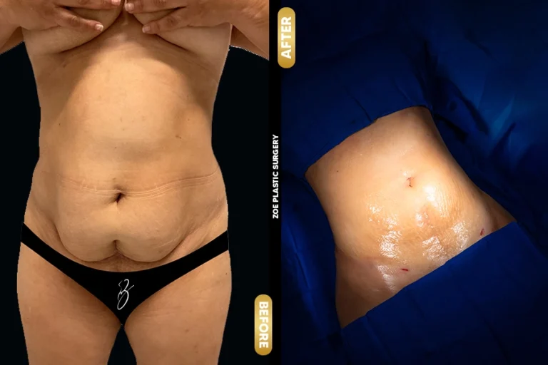 Liposuction 360 in Miami