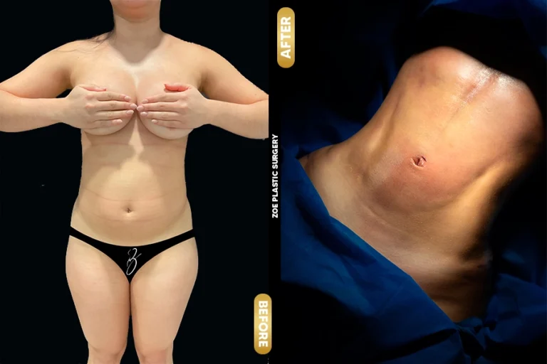 Lipo in Zoe Plastic Surgery